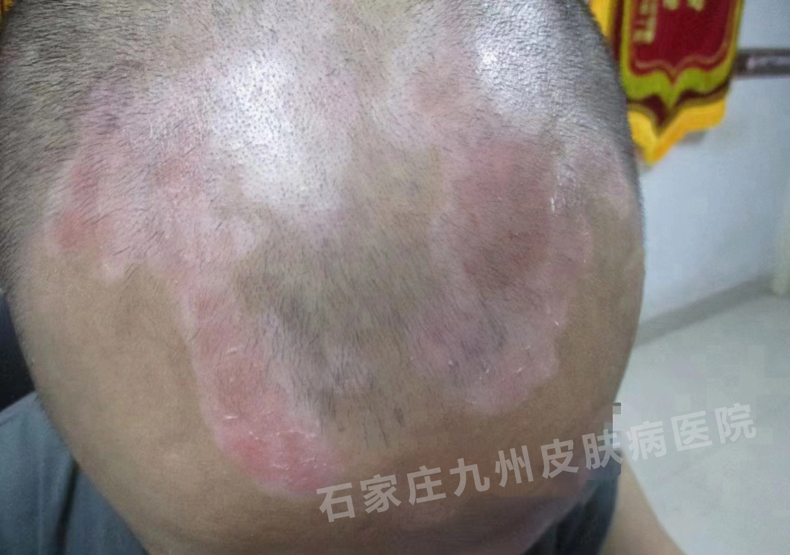 白癜风发病和血热有没有关系呢?