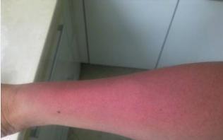 过敏性皮炎会不会引起全身起疹子?