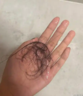 斑秃就是秃头吗，有什么不同?