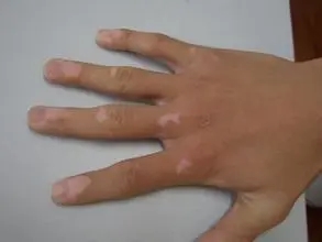 白癜风是单发的还是多发的?