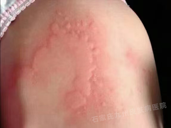 荨麻疹会不会每个部位都会出现?