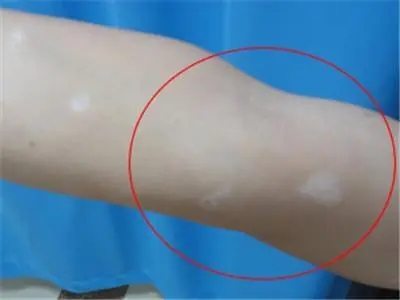 胳膊上出现白斑是不是白癜风?