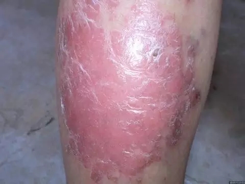 牛皮癣会引起皮肤出现发热现象吗?