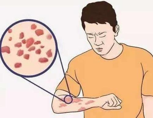胆碱性荨麻疹是运动后出现的吗?