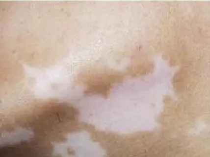 白癜风早期扩散的速度快吗?