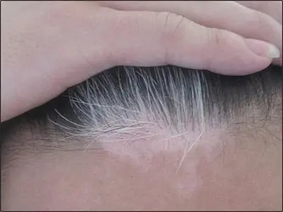 白癜风会导致白头发增多吗?
