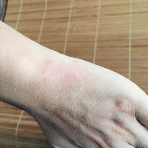 荨麻疹会引起患者出现手指肿胀吗?