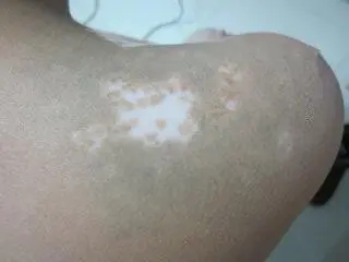 散发型白癜风是不是面积不大?