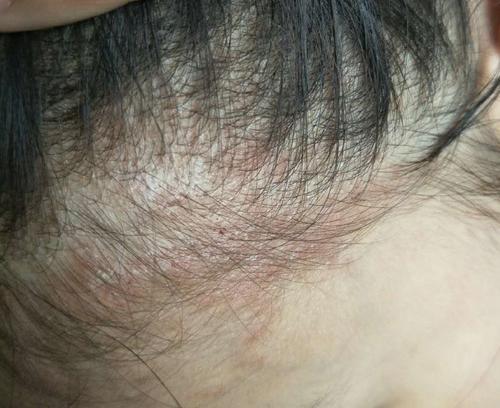 头部银屑病早期是什么红疹呢?